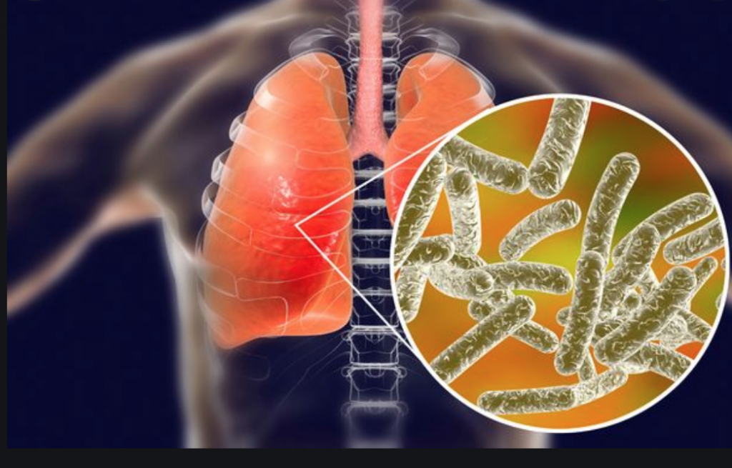 suspected legionnaires' disease