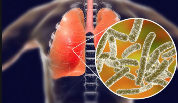suspected legionnaires' disease